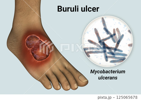 Buruli ulcer on a patient foot, 3D illustration. The disease caused by Mycobacterium ulcerans bacteria Buruli ulcer on a patient foot, 3D illustration. The disease caused by Mycobacterium ulcerans bacteria 125065678