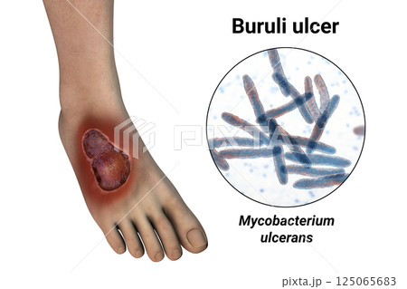 Buruli ulcer on a patient foot, 3D illustration. The disease caused by Mycobacterium ulcerans bacteria 125065683