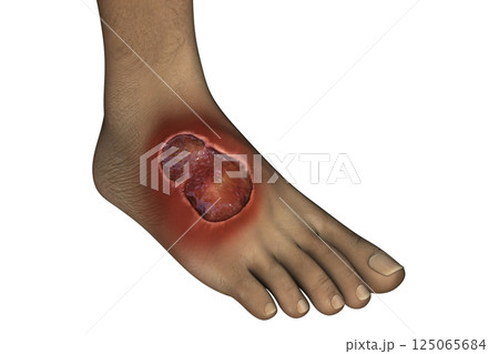 Buruli ulcer on a foot, 3D illustration. The disease caused by Mycobacterium ulcerans bacteria Buruli ulcer on a foot, 3D illustration. The disease caused by Mycobacterium ulcerans bacteria 125065684