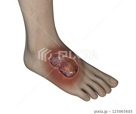 Buruli ulcer on a foot, 3D illustration. The disease caused by Mycobacterium ulcerans bacteria Buruli ulcer on a foot, 3D illustration. The disease caused by Mycobacterium ulcerans bacteria 125065685