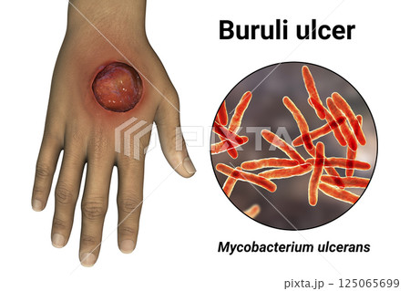 Buruli ulcer on an arm, 3D illustration. The disease caused by Mycobacterium ulcerans bacteria 125065699