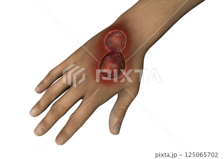 Buruli ulcer on an arm, 3D illustration. The disease caused by Mycobacterium ulcerans bacteria 125065702