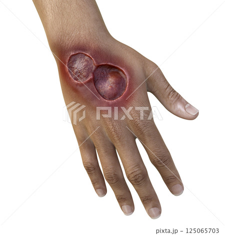 Buruli ulcer on an arm, 3D illustration. The disease caused by Mycobacterium ulcerans bacteria 125065703