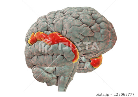 Human brain with highlighted superior temporal gyrus 125065777