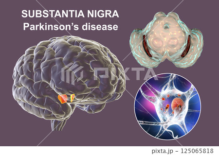 Substantia nigra, a basal banglia of the midbrain, in Parkinson's disease 125065818