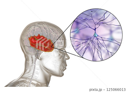 Human brain with highlighted temporal lobe and close-up view of neurons Human brain with highlighted temporal lobe and close-up view of neurons 125066013