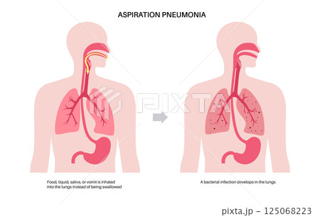 Aspiration pneumonia poster 125068223