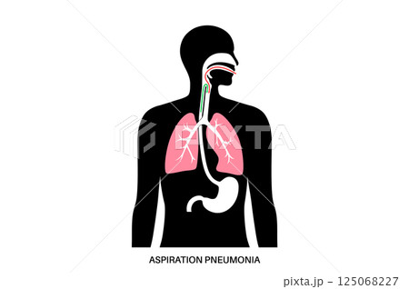 Aspiration pneumonia poster Aspiration pneumonia poster 125068227
