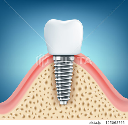 Dental implant schematic close-up. Vector illustration. 125068763