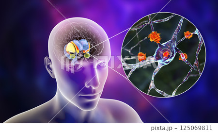 Dorsal striatum and lateral ventricles in the brain of a person with Huntington's disease, 3D illustration 125069811