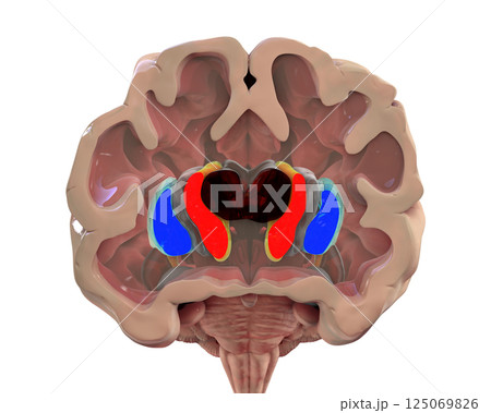 Coronal section of a brain of a person with Huntington's disease 125069826