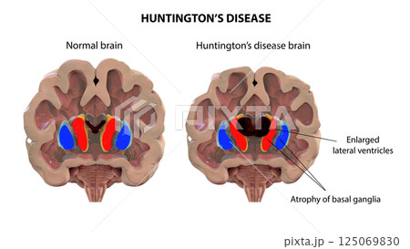 Coronal section of a brain of a person with Huntington's disease 125069830
