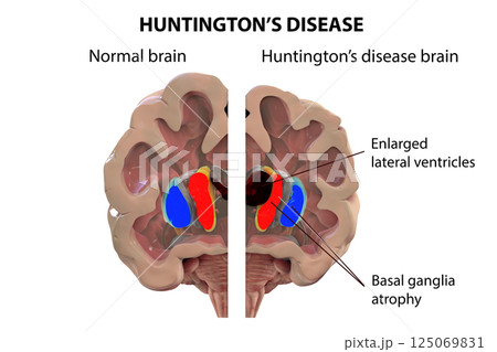 Coronal section of a brain of a person with Huntington's disease 125069831