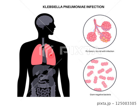 Klebsiella pneumoniae poster Klebsiella pneumoniae poster 125083385
