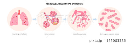 Klebsiella pneumoniae poster Klebsiella pneumoniae poster 125083386