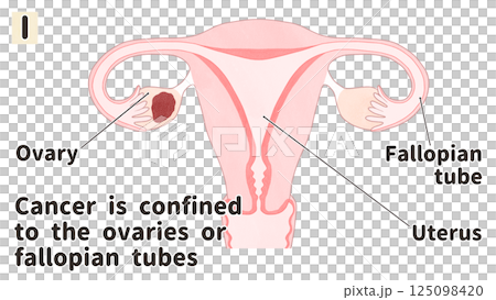 Ovarian cancer stage I (first stage) - Easy-to-understand English illustrations Ovarian cancer stage I (first stage) - Easy-to-understand English illustrations 125098420