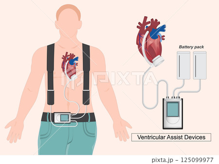 A Ventricular Assist Device (VAD) is a mechanical pump. 125099977