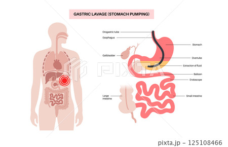 Stomach wash gastric lavage Stomach wash gastric lavage 125108466
