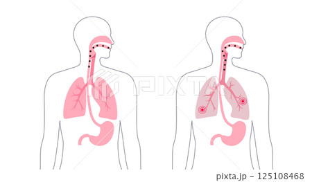 Aspiration pneumonia poster Aspiration pneumonia poster 125108468