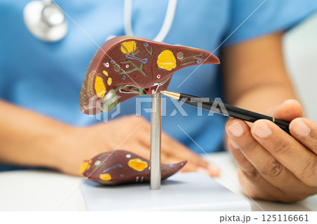 Cirrhosis, Liver cancer, fatty liver, Asian doctor with liver human anatomy model in World Hepatitis Day at hospital. Cirrhosis, Liver cancer, fatty liver, Asian doctor with liver human anatomy model in World Hepatitis Day at hospital. 125116661