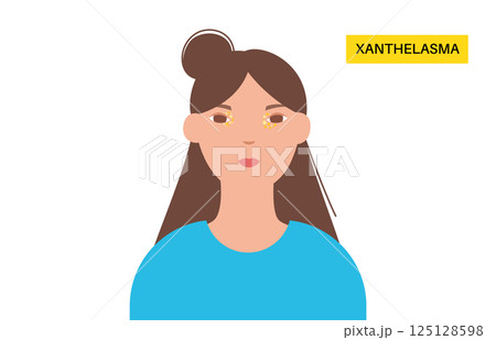 Xanthelasma skin disease 125128598