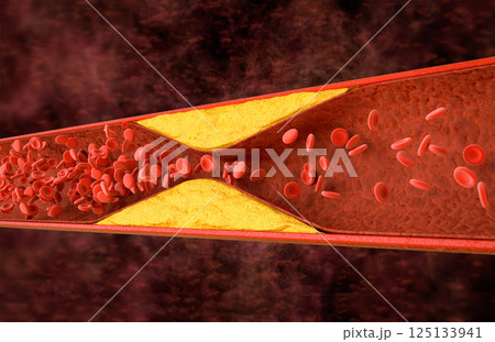 Atherosclerosis with cholesterol blood or plaque in vessel cause of coronary artery disease 125133941