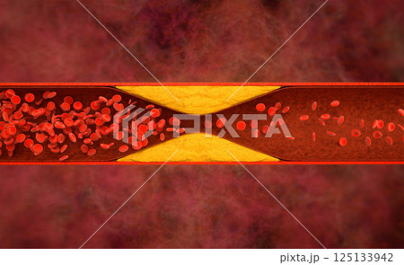 Atherosclerosis with cholesterol blood or plaque in vessel cause of coronary artery disease 125133942