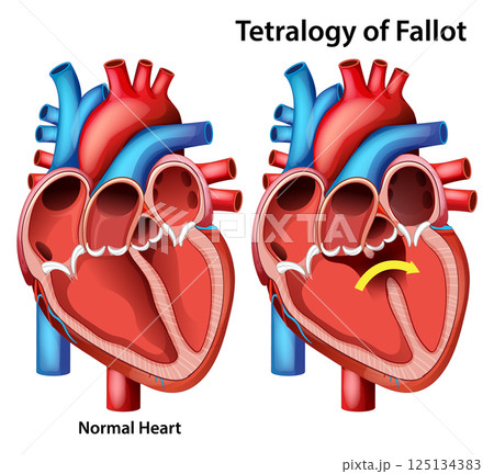 Comparison of Normal Heart and Tetralogy of Fallot 125134383