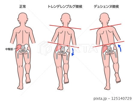 トレンデレンブルグ徴候とデュシェンヌ徴候の人体 トレンデレンブルグ徴候とデュシェンヌ徴候の人体 125140729