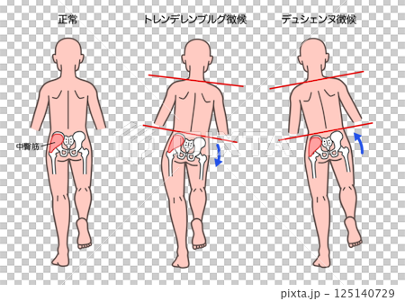 トレンデレンブルグ徴候とデュシェンヌ徴候の人体 トレンデレンブルグ徴候とデュシェンヌ徴候の人体 125140729