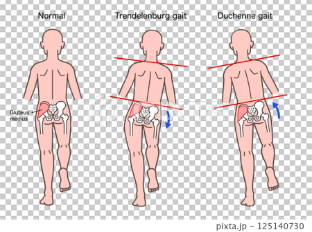 Trendelenburg and Duchenne signs in the human body Trendelenburg and Duchenne signs in the human body 125140730