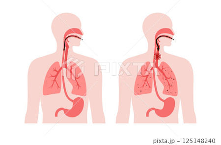 Aspiration pneumonia poster Aspiration pneumonia poster 125148240