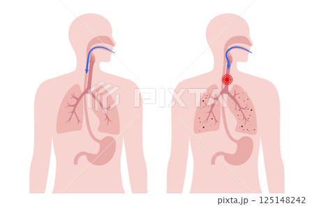 Aspiration pneumonia poster Aspiration pneumonia poster 125148242