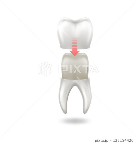 Illustration of Dental Crown Procedure for Tooth Restoration Illustration of Dental Crown Procedure for Tooth Restoration 125154426
