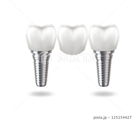 Realistic dental implants on white background Realistic dental implants on white background 125154427