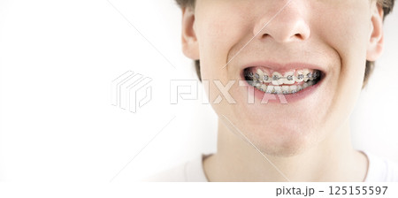 A teenager with dental braces holds interdental brush for cleaning teeth. 125155597