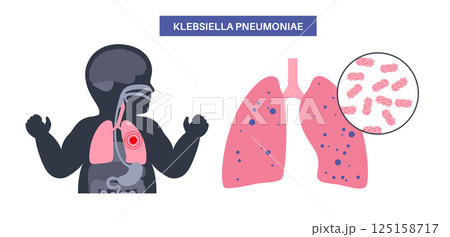 Klebsiella pneumoniae poster Klebsiella pneumoniae poster 125158717