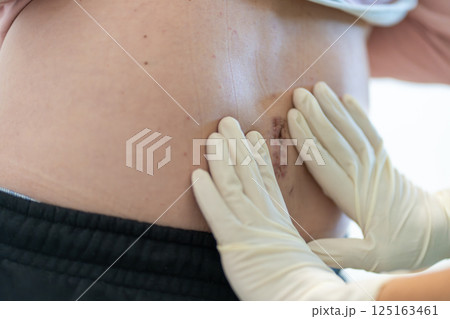 Doctor examining healing wound on patient back Doctor examining healing wound on patient back 125163461