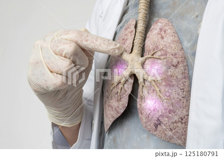 Doctor pointing at lungs model with highlighted problem areas in medical examination 125180791