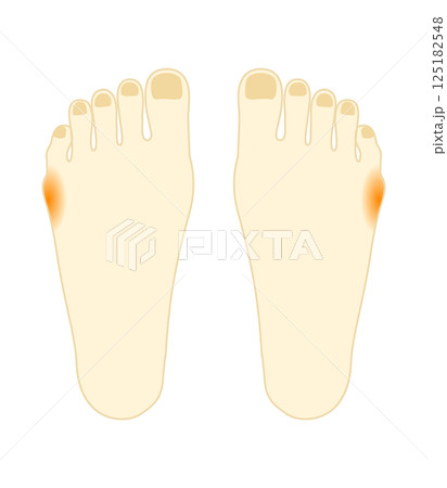 内反小趾が痛い 足のイラスト 内反小趾が痛い 足のイラスト 125182548