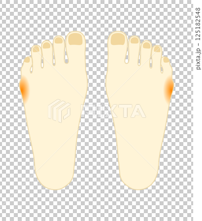 内反小趾が痛い 足のイラスト 内反小趾が痛い 足のイラスト 125182548