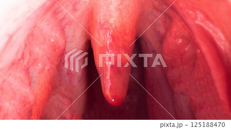 Inflammation of the uvula in the oral cavity due to infection and virus. Treatment of the disease is uvulitis. Red throat due to illness, close-up. Allergy Inflammation of the uvula in the oral cavity due to infection and virus. Treatment of the disease is uvulitis. Red throat due to illness, close-up. Allergy 125188470