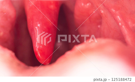 Red, inflamed and swollen uvula in the throat. Treatment of uvulitis due to bacteria and streptococcal viruses. Otolaryngology, macro. Copy space for text. Allergy Red, inflamed and swollen uvula in the throat. Treatment of uvulitis due to bacteria and streptococcal viruses. Otolaryngology, macro. Copy space for text. Allergy 125188472
