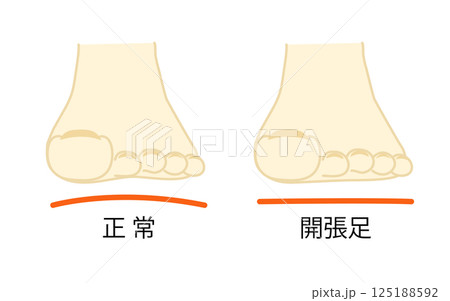 正常な足先と開張足のイラスト 125188592