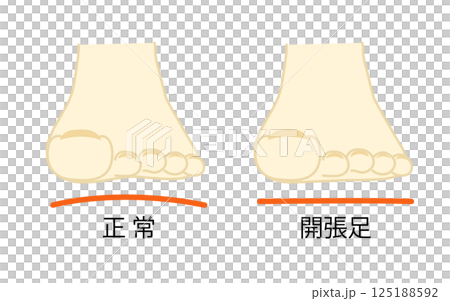 正常な足先と開張足のイラスト 125188592