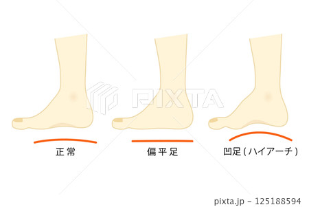 正常な足と凹足・偏平足のイラストセット 正常な足と凹足・偏平足のイラストセット 125188594
