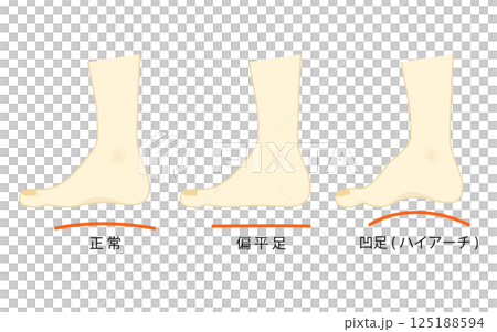 正常な足と凹足・偏平足のイラストセット 正常な足と凹足・偏平足のイラストセット 125188594