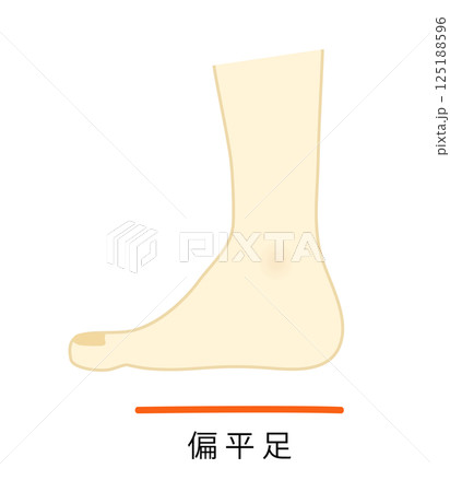偏平足のイラスト 125188596