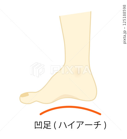 凹足(ハイアーチ)の足のイラスト 凹足(ハイアーチ)の足のイラスト 125188598