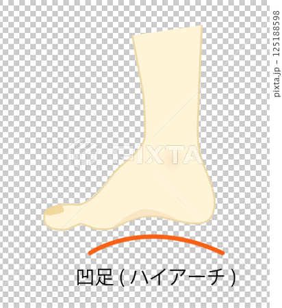 Illustration of a high arched foot Illustration of a high arched foot 125188598